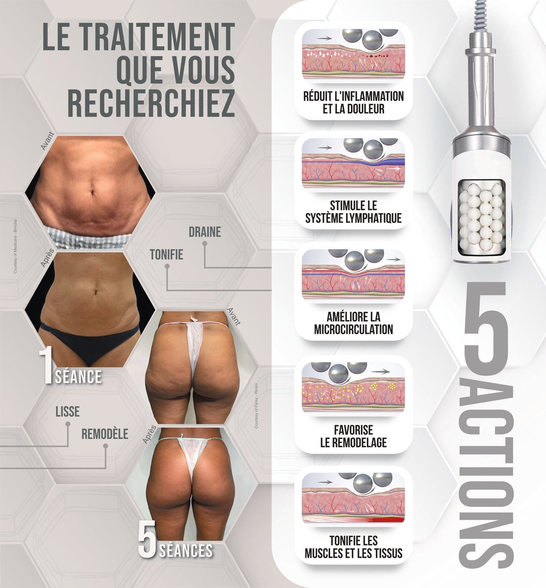 Qu’est-ce que la cellulite ? Comprendre, ressentir, agir !
