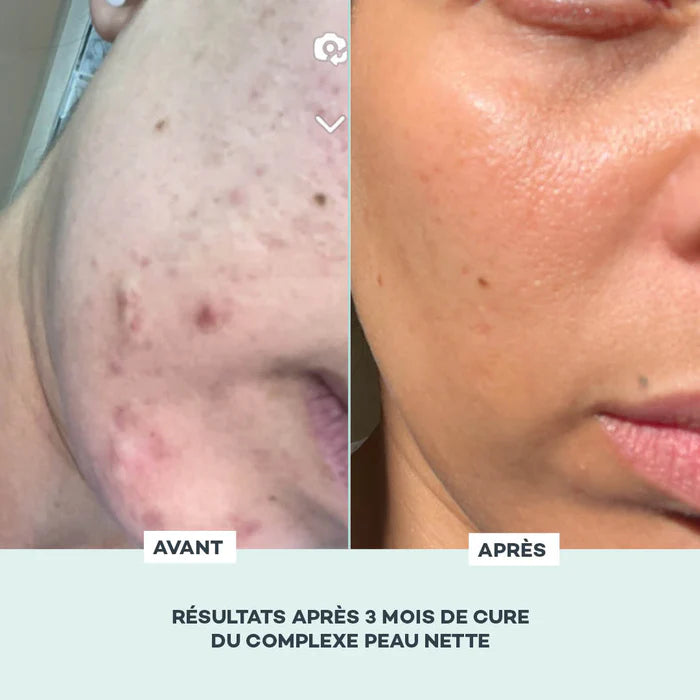 D-LAB Complexe Peau Nette – 1 mois (56 gélules) – Peau Nette, Sébum Régulé & Grain Uniforme